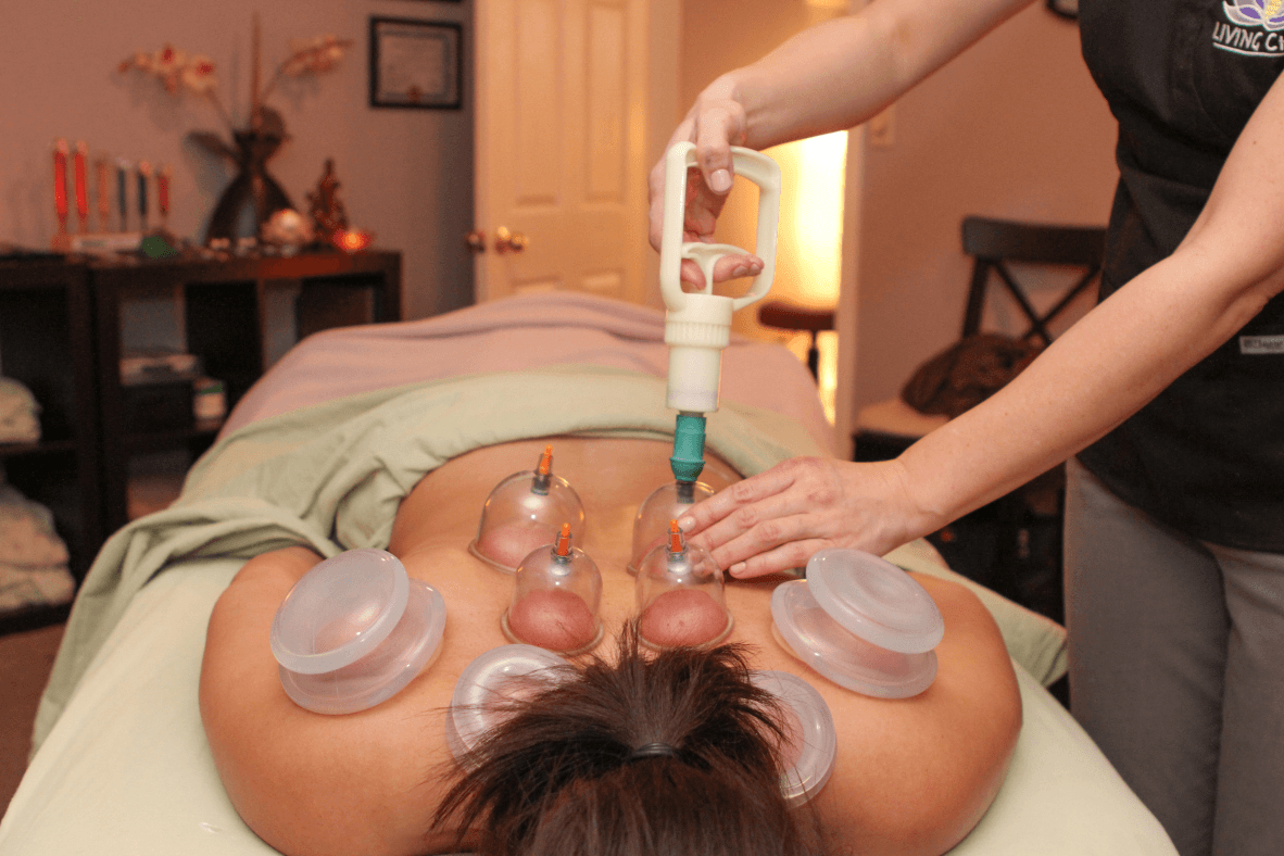 Image for Cupping Therapy